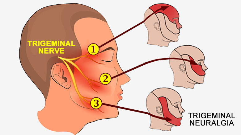 Relief from Trigeminal Neuralgia with Ayurveda