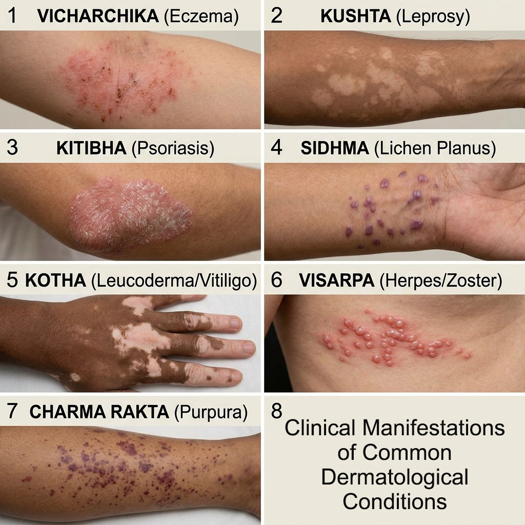 Mahakushta - Major Skin Diseases